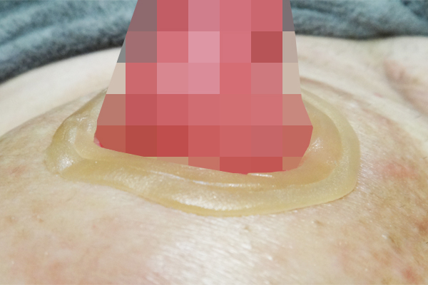 KenUストーマ周囲へのアダプト皮膚保護シール2重巻き